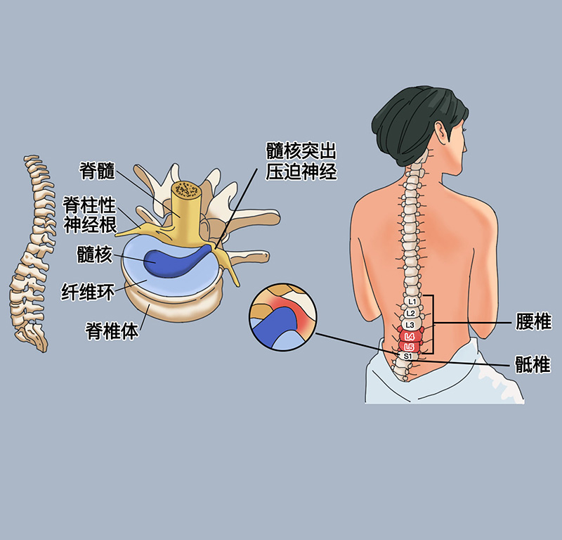 腰椎间盘突出如何预防？